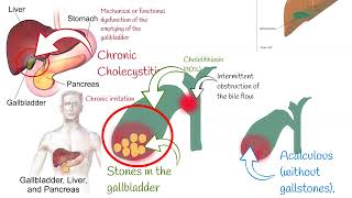 Cholecystitis Signs and symptoms Chronic and acute Cholecystitis biliary colic [upl. by Eillit681]