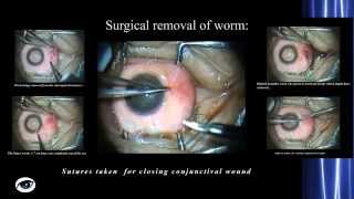 Ocular Loiasis Case Report with surgical removal [upl. by Massab]