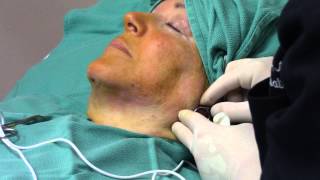 ThermiTight  ThermiRF Treatment for Neck Laxity and Sagging  Radiofrequency RF Neck Tightening [upl. by Del]