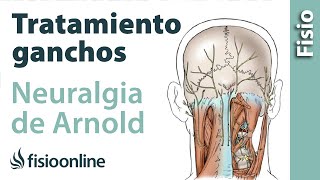 Tratamiento de fisioterapia con ganchos para la neuralgia de Arnold o neuralgia occipital [upl. by Enial]