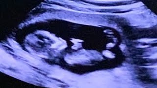 NT Scan at 13 Weeks Pregnancy  Nuchal Translucency Scan 1114 Weeks Pregnancy [upl. by Allyce]