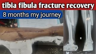 tibia fibula fracture recovery 8 months my journey mujhy aaj 8 mahene hugye [upl. by Monro]