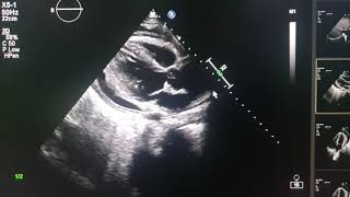 effuso constrictive pericarditis echocardiography [upl. by Roberson]