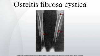 Osteitis fibrosa cystica [upl. by Lenz]