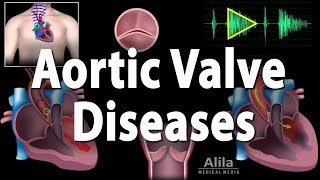 Aortic Valve Disease Animation [upl. by Einnalem482]