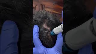 Best Treatment for Dandruff  Keravive HydraFacial [upl. by Lliw]