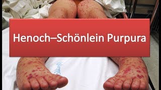 HenochSchönlein Purpura [upl. by Sneed]