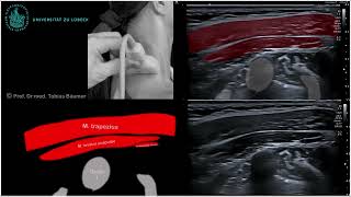 Sonographische Darstellung der seitlichen Nackenmuskeln [upl. by Ahsinauj980]