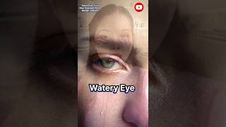 Symptoms of eye strain part 2 wait for part 3 Swaineyeclinic headache eye pain irritating eye [upl. by Lahsram]