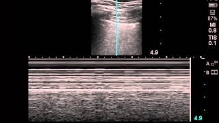 ultrasound diagnosis of pneumothorax [upl. by Egreog]