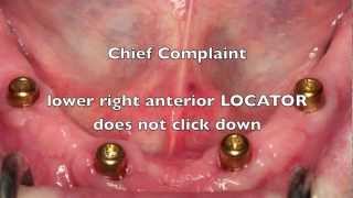 NEW Locator Dental Implant Attachments  Workshop Tips [upl. by Vivia]