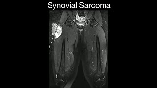 Synovial Sarcoma 1 [upl. by Rimaa327]