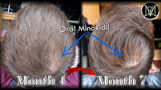 Oral Minoxidil Loniten Results in 7 Months [upl. by Zwart]