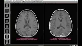 CNS tuberculoma [upl. by Korman]