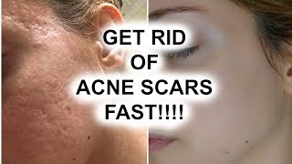 HOW TO GET RID OF ACNE SCARS  Pershii [upl. by Nois]