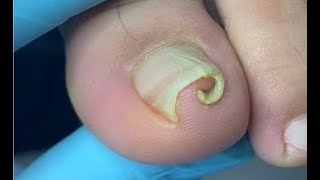 How to repair curved nails [upl. by Enitnemelc715]