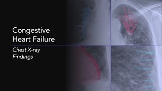 Congestive Heart Failure Explanation of Chest Xray Findings [upl. by Herrera]