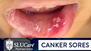 Determining Causes amp Treatment for Canker Sores  SLUCare Otolaryngology [upl. by Alrad]