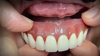 Finalizing a Highly Esthetic Denture with Dentist amp Patient InLab [upl. by Alilahk160]