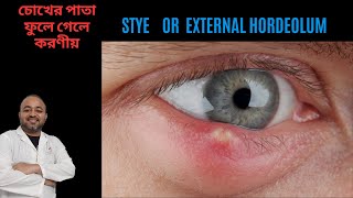 Stye  Chalazion  Treatment of external hordeolum  অঞ্জনি কি কেন হয় চিকিৎসা ও করণীয় কি [upl. by Roosnam]