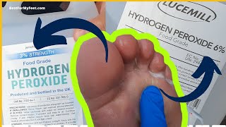 3 vs 6 Hydrogen Peroxide For Athlete Foot Fungus Which One Works [upl. by Fredie]