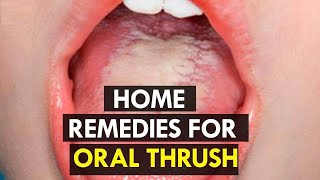 How to Treat Candida at Home  5 Home Remedies for Oral Thrush [upl. by Ardaed]