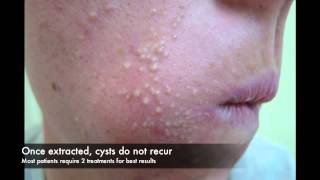 Acne cyst laser treatment [upl. by Leavelle]