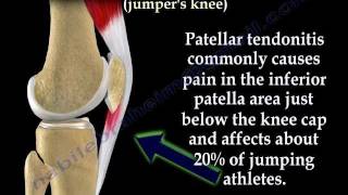 Patellar Tendonitis Jumpers Knee  Everything You Need To Know  Dr Nabil Ebraheim [upl. by Casandra]