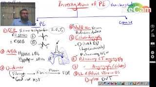 Pulmonary Embolism 1  Investigations [upl. by Eimmit]