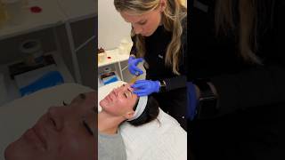 Microneedling  PRP Vampire Facial [upl. by Alvarez738]