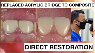 Change Dental Bridge Acrylic to Direct Composite  General Dentist Griya RR [upl. by Navanod]