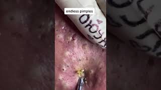 endless pimple [upl. by Aramak]