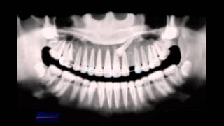 Treatment of impacted canine [upl. by Asined]