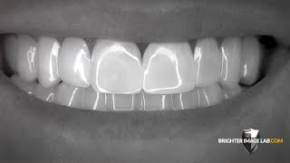 Brighter Image Lab BilVeneers™ The Future of No Dentist Dental Veneers [upl. by Nahgam]