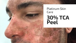 Platinum Skin Care 30 TCA demo vegan [upl. by Jilly]