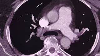 Pulmonary Embolism  CT scan [upl. by Digdirb428]