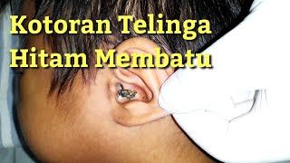 Mengeluarkan Kotoran Telinga Anak [upl. by Boyden]