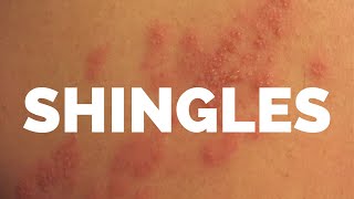 SHINGLES  My Personal Experience and how I healed my SHINGLES [upl. by Enyalaj697]