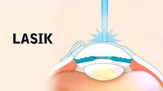 LASIK Surgery and its Risks [upl. by Menis]