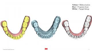 3M™ Clarity™ Aligners Case Study Dr Hughes [upl. by Marpet499]