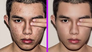 AFFORDABLE SKIN CARE ROUTINE FOR ACNE DARK MARKS AND HYPERPIGMENTATION [upl. by Agn]