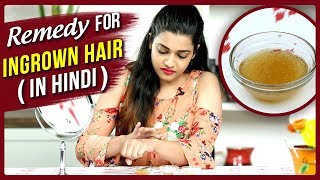 Ingrown Hair Removal At Home  Remedy For Ingrown Hair In Hindi  DIY  Ingrown Hair Treatment [upl. by Klos]