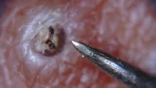 Itchy ingrown hair removed [upl. by Brown504]