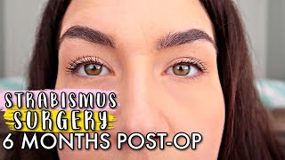 ESOTROPIA STRABISMUS SURGERY UPDATE 6 MONTHS POSTOP 2020  STRABISMUS SURGERY Before And After [upl. by Assiralc]