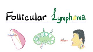 Follicular Lymphoma  Indolent BCell Lymphoma  NonHodgkin’s Lymphoma  Hematology [upl. by Laenej]