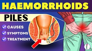 Hemorrhoids Piles Symptoms Causes Treatment  Piles problem treatment  Hemorrhoids symptoms [upl. by Nnylkcaj]