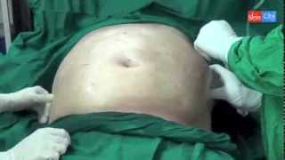 Alma Lipo EZE Laser Liposuction at SkinCity Pune India Dr Dhepe [upl. by Dorsy194]