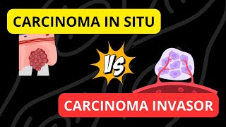 Carcinoma in situ versus Carcinoma invasor [upl. by Notserp]