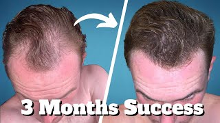 TOPICAL FINASTERIDE The GREATEST Underrated Hair Remedy [upl. by Tat]