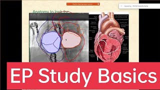 Basics of Cardiac electrophysiologic study part 1 epstudy ablation SVT EPS drnarendrakumar [upl. by Lark]